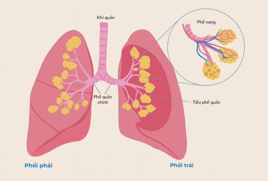 copd